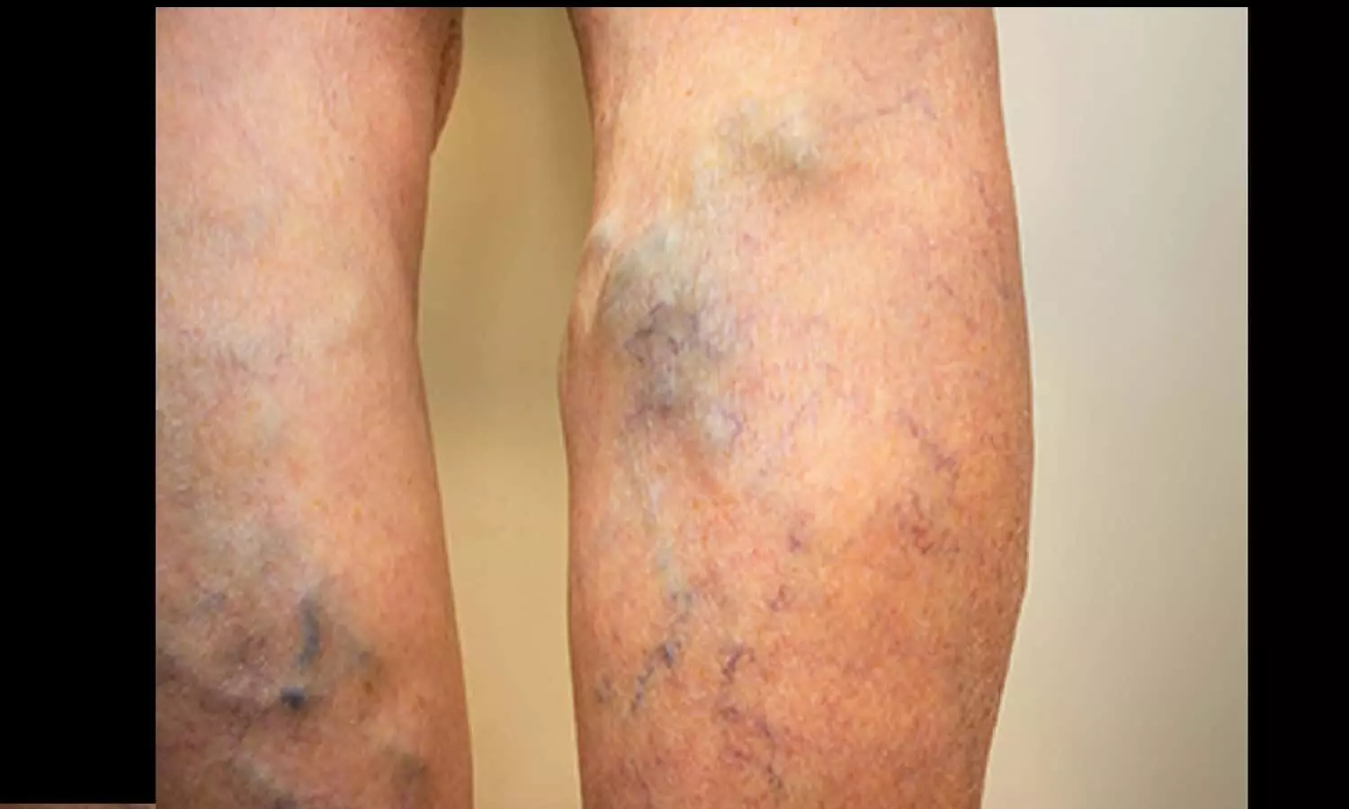 varicose veins