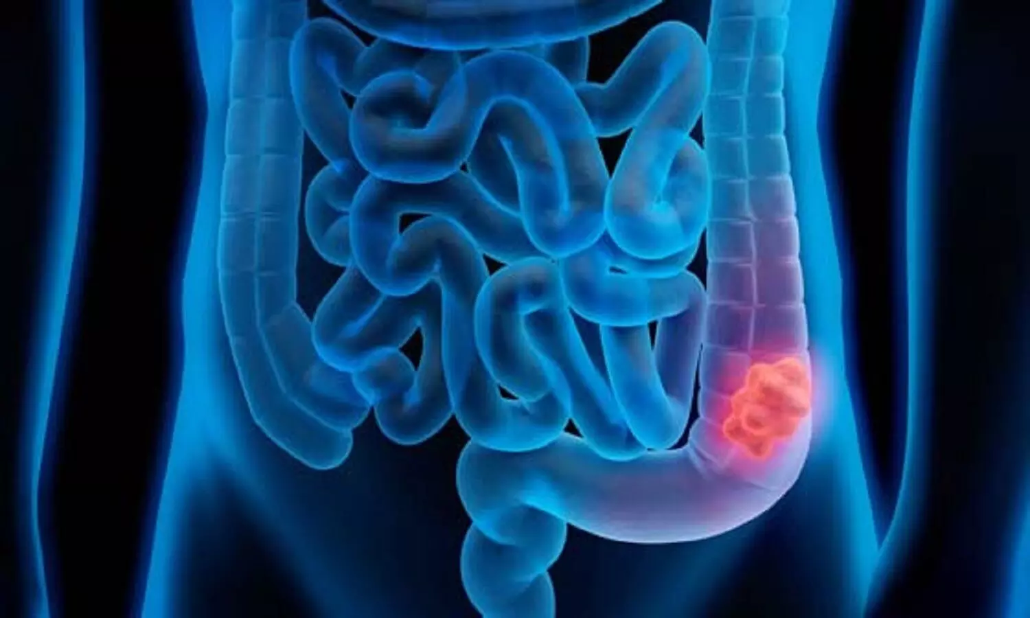 Colon Cancer : इन चीजों से होता है पेट का कैंसर, आज से ही करें तौबा